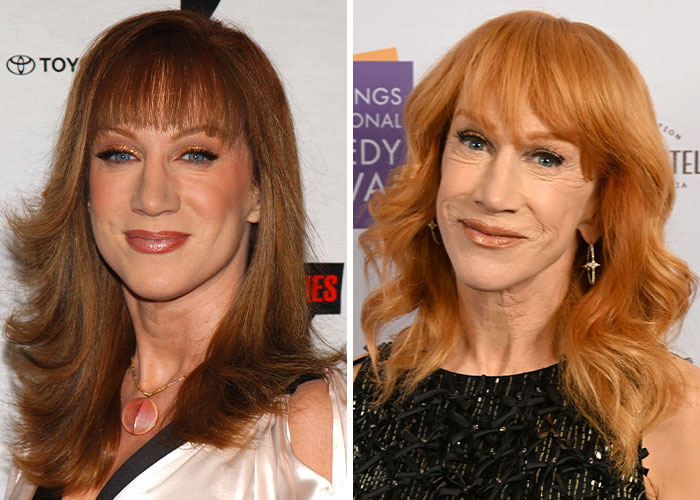 Two images of a celebrity before and after plastic surgery, showcasing changes in appearance.