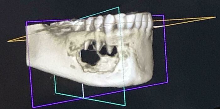 3D scan of a human jawbone with missing teeth showing bizarre and fascinating details of the human body.