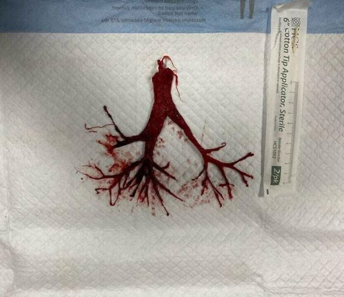 Blood clot shaped like a lung bronchial tree on medical gauze, illustrating uncanny moments in medicine.