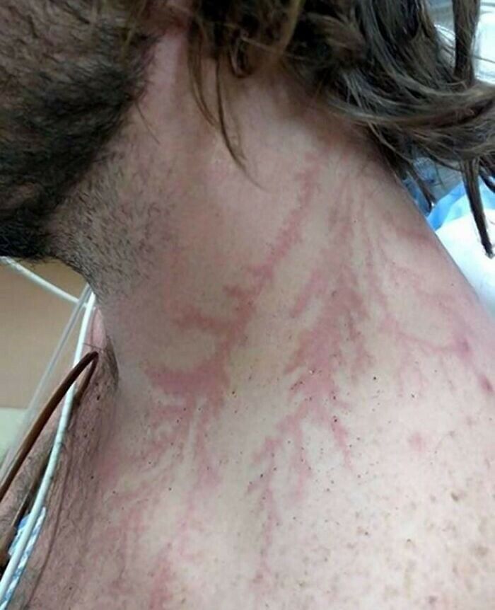 Close-up of a human neck showing bizarre skin patterns and red markings on the body in a medical setting.