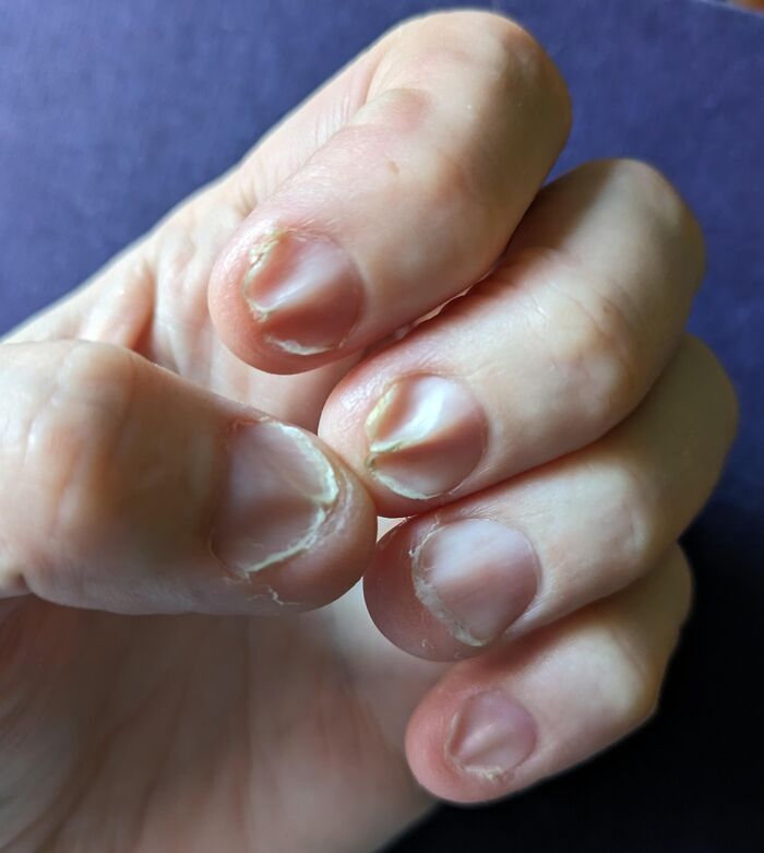 Close-up of human fingernails with peeling skin, showcasing bizarre and fascinating details of the human body.
