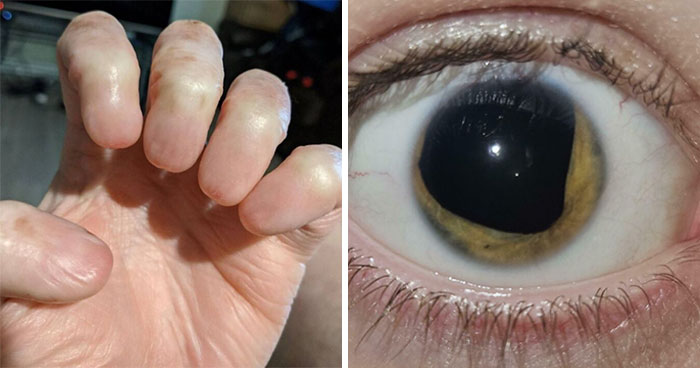 “I Have (Almost) No Eye Colour”: 40 Fascinating And Wild Things That Can Happen To The Human Body (New Pics)